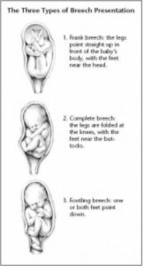 Breech positions